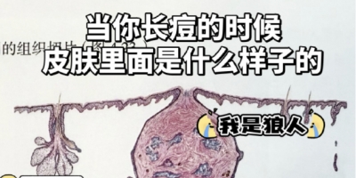 皮肤爆痘留印又留坑的真相